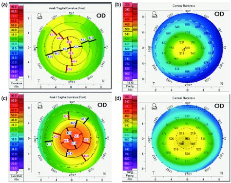 central corneal thickness measurement|central corneal thickness normal range.